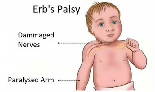 How to Take Care of a Baby with Erb's Palsy  image